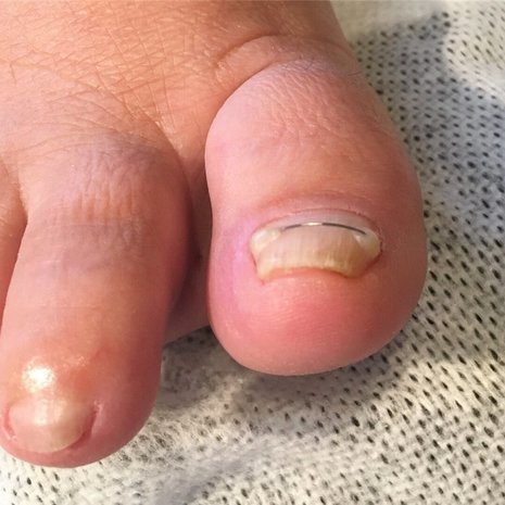 thumb