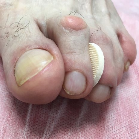thumb