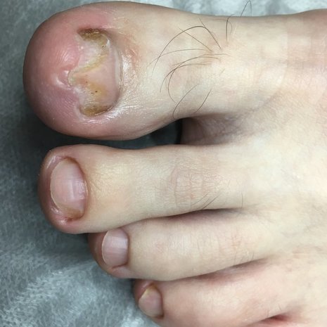 thumb