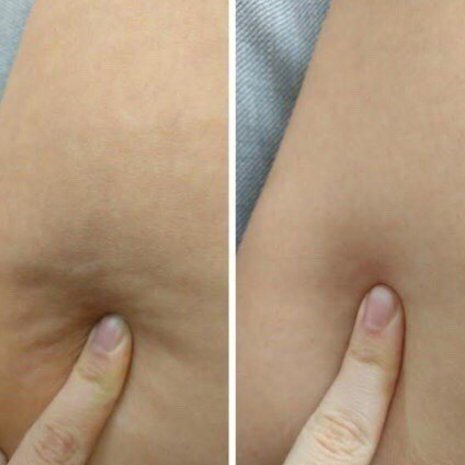 thumb