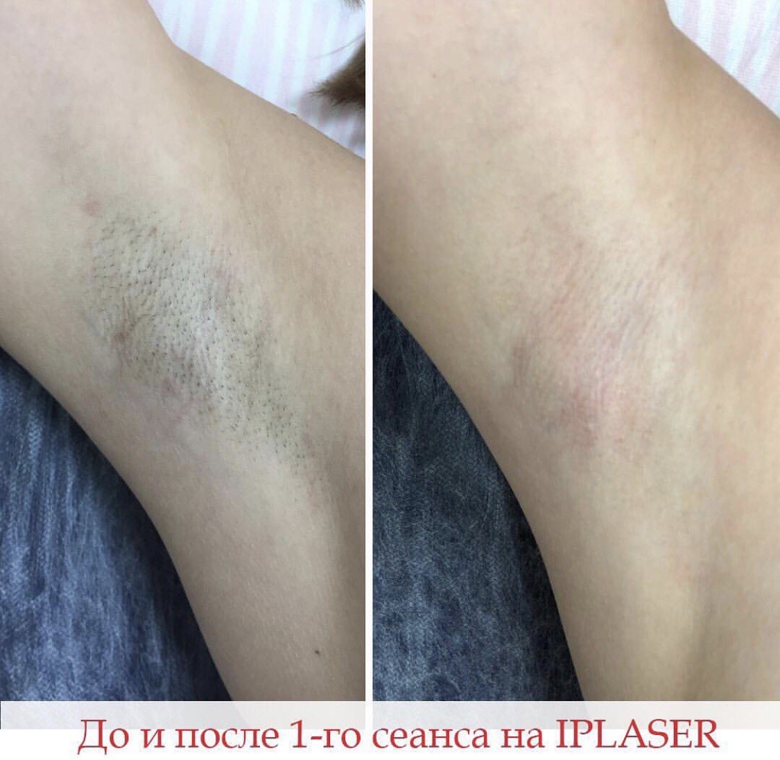 Лазерная эпиляция эффект после первой процедуры. Лазерная эпиляция до и после. Лазерная эпиляция глубокое бикини. Лазерная эпиляция эффект после первой процедуры. Лазерная эпиляция.