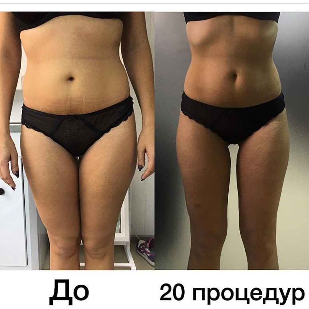 Миостимуляция тела результаты фото до и после