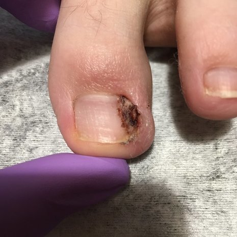 thumb