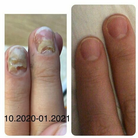 thumb