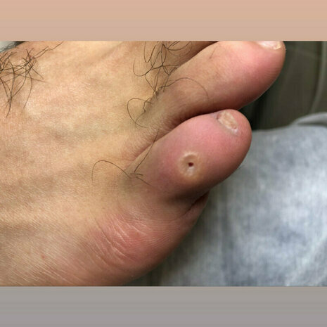 thumb