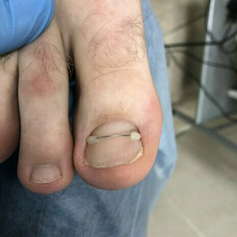thumb