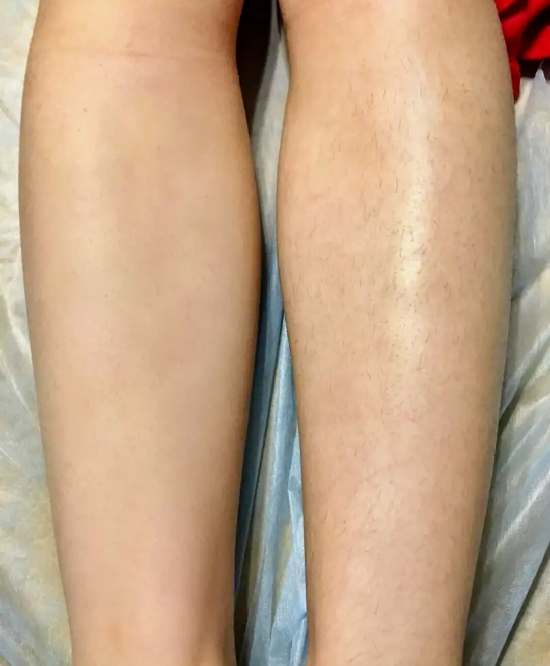 До и после шугаринга фото ног