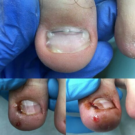 thumb