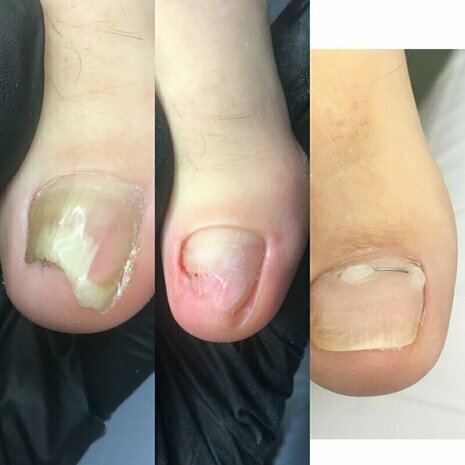 thumb