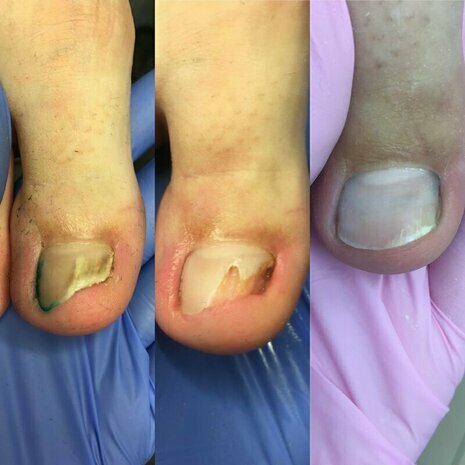 thumb