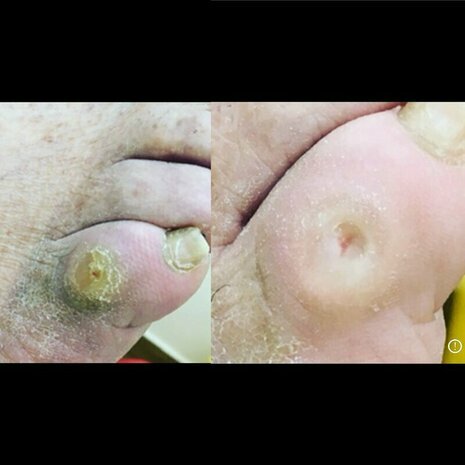 thumb