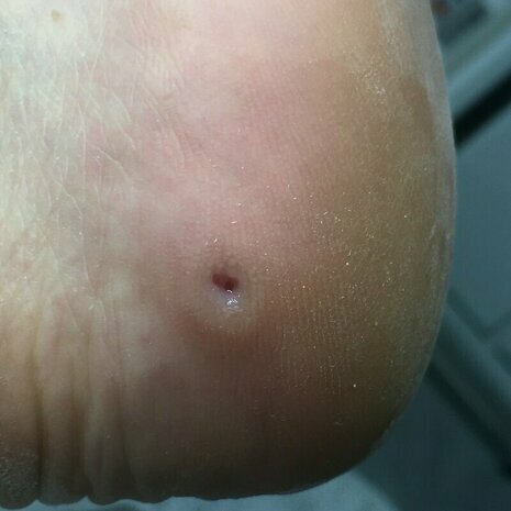 thumb