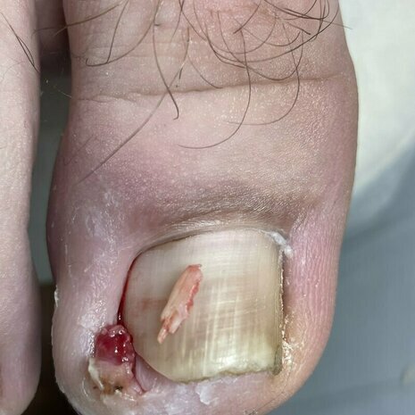 thumb