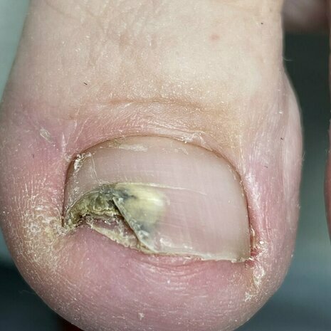 thumb