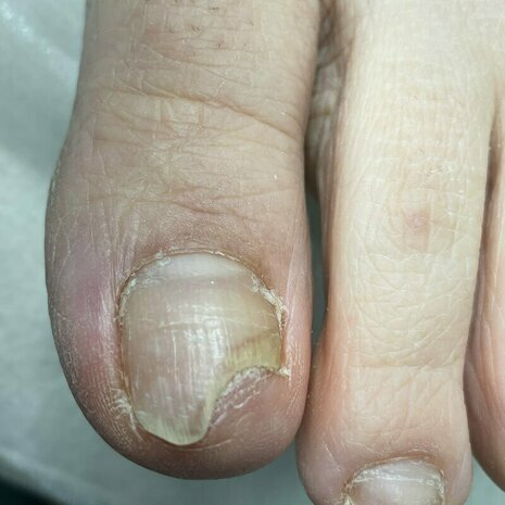 thumb