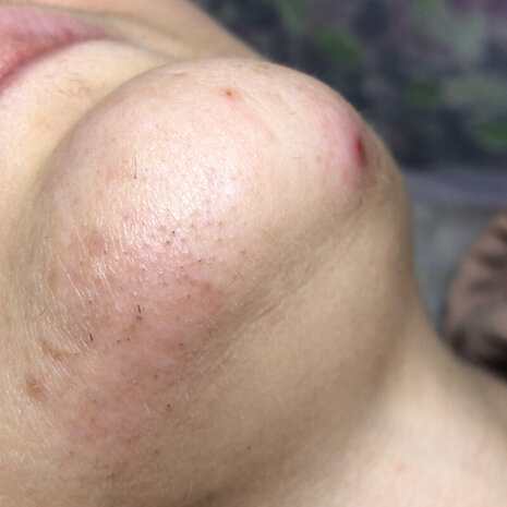 thumb