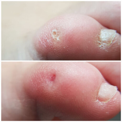 thumb