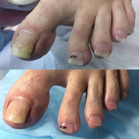 thumb