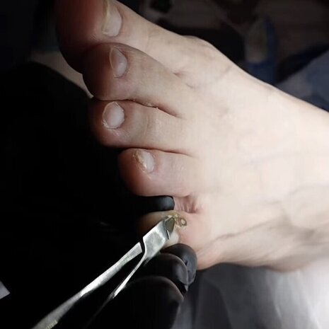 thumb