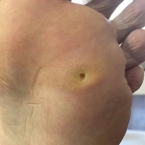 thumb