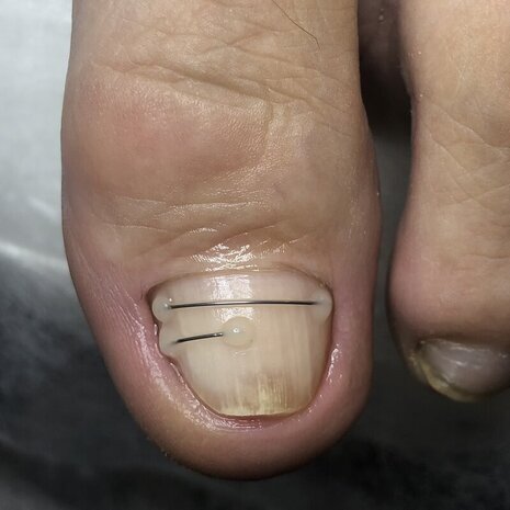 thumb