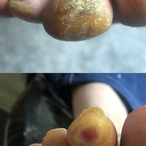 thumb