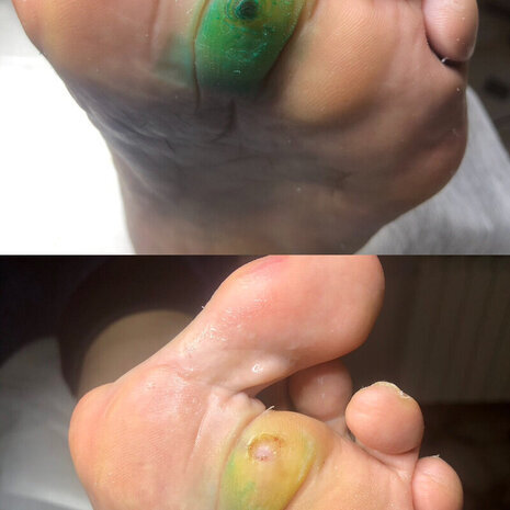 thumb