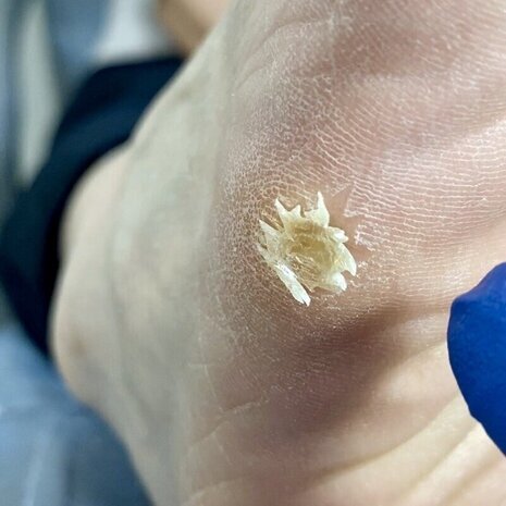 thumb