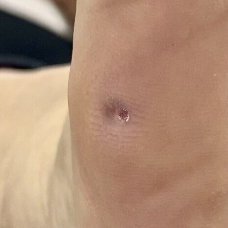 thumb
