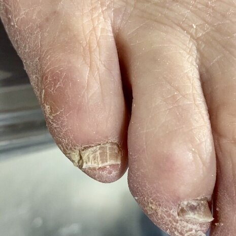 thumb