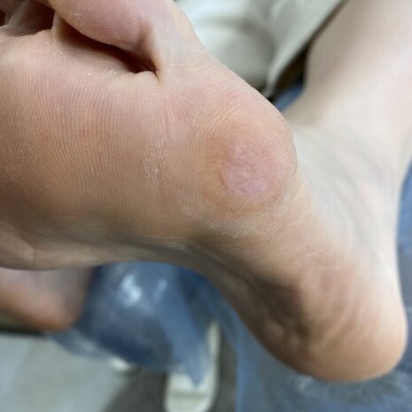 thumb