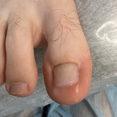 thumb