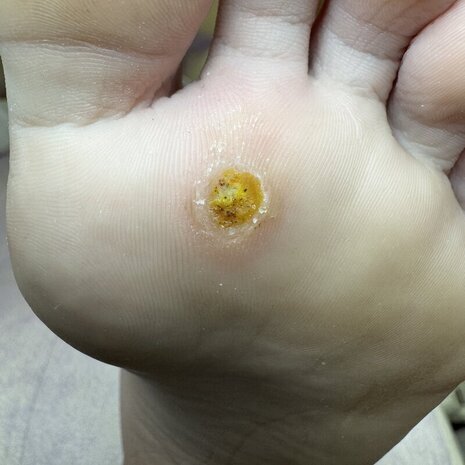 thumb