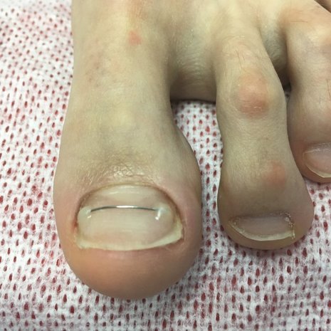 thumb